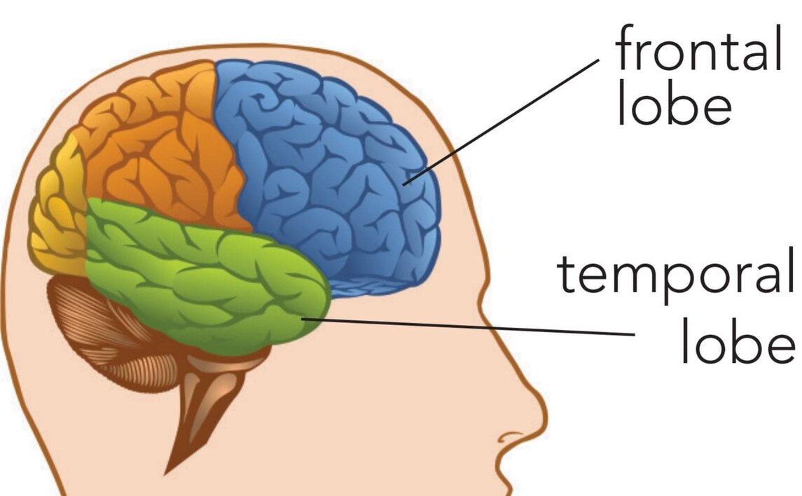 Alzheimer's diseased brain compared to a normal one